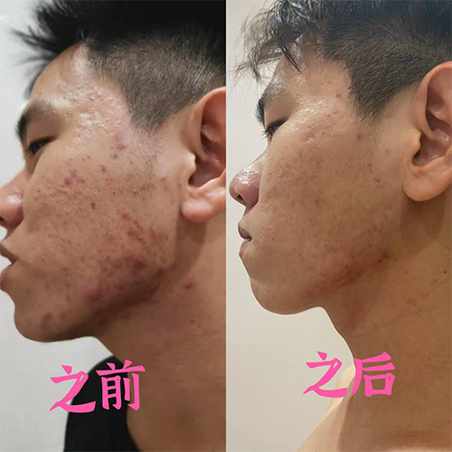acne issue solved after follow coach plan